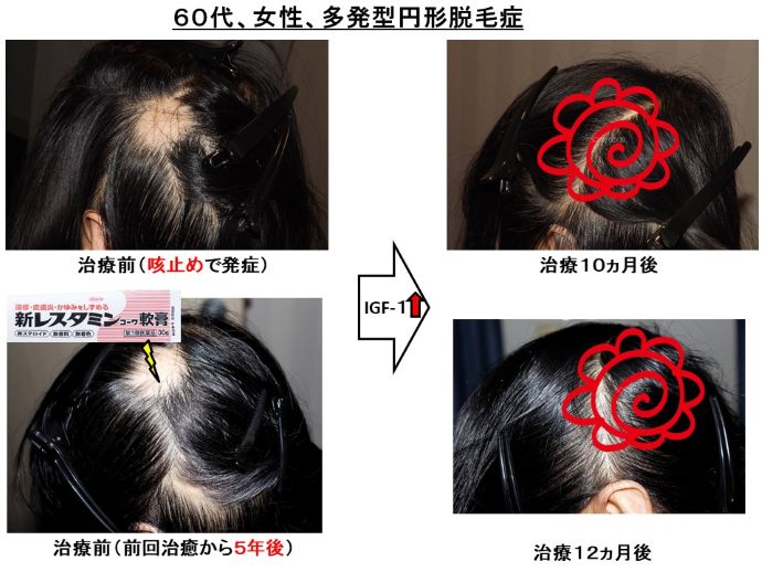 円形脱毛症　病院